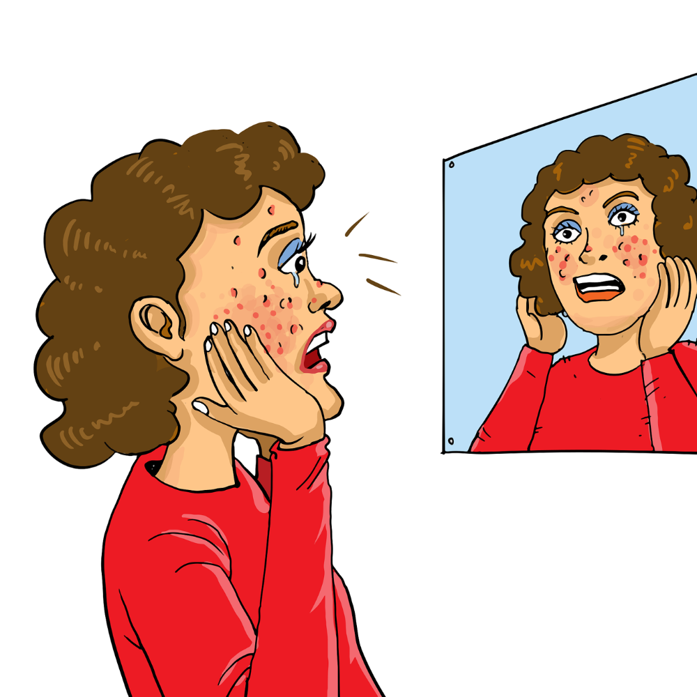 Acne Myths Debunked