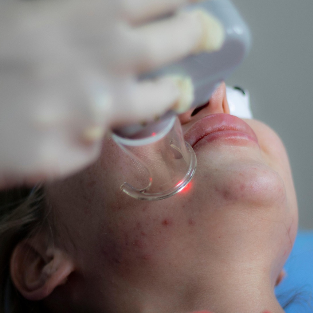 Laser Treatment for Acne Scarring: What the Research and Real People Actually Say